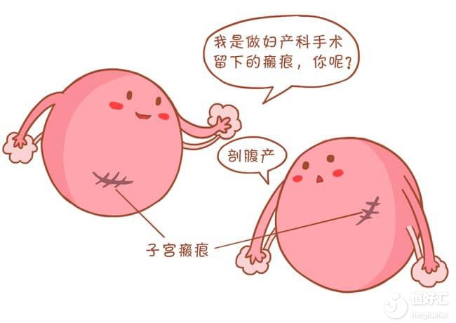 瘢痕子宮是什么？能做試管嬰兒嗎？